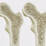 Osteoporosis Stages