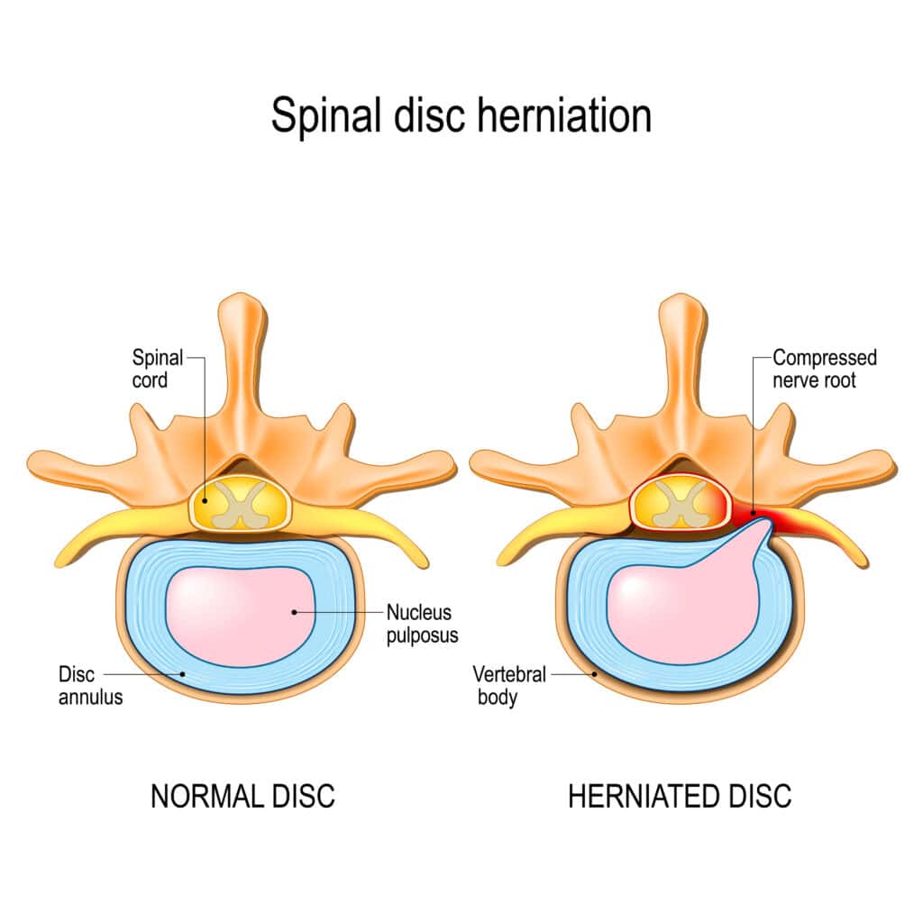 disk herniation