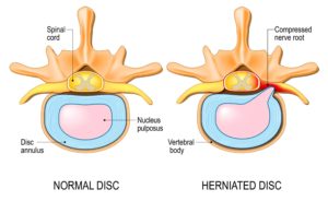 disk herniation