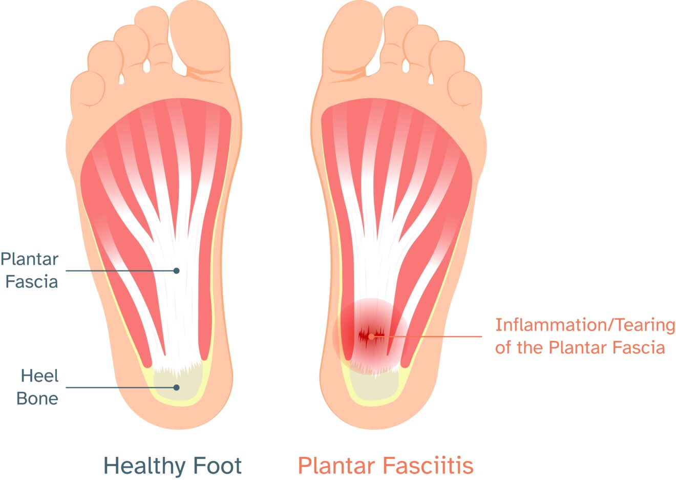 Printable Plantar Fasciitis Exercises And Fact Sheet Physio Ed