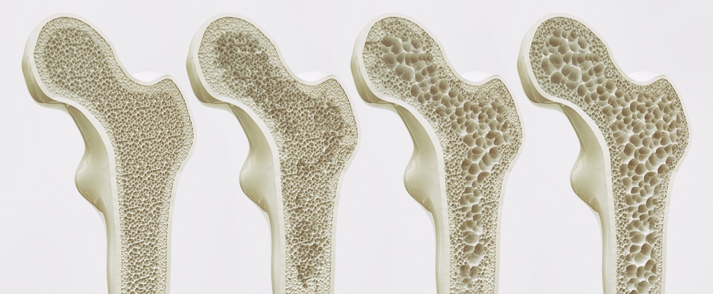osteoporosis 4 stages