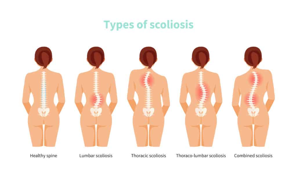 Graphic illustrating the types of degenerative scoliosis.
