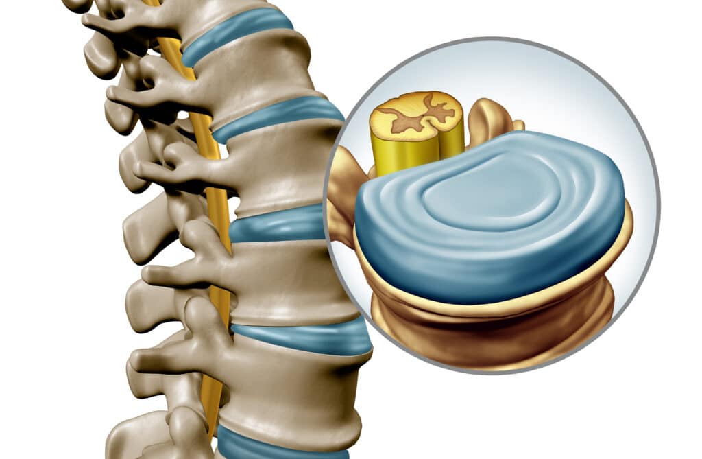 Lumbar Traction: Digital 3D image of lumbar spine and disks.