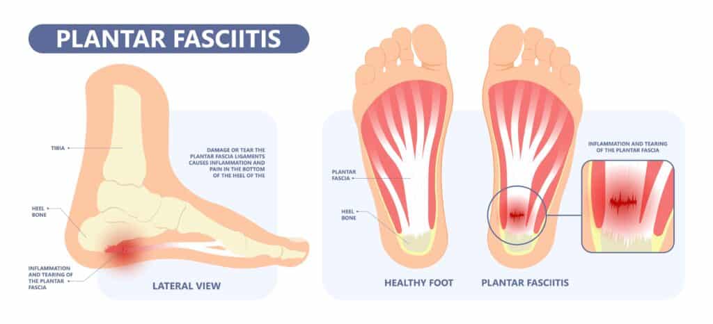 Graphic image of the foot and areas affected by plantar fasciitis.