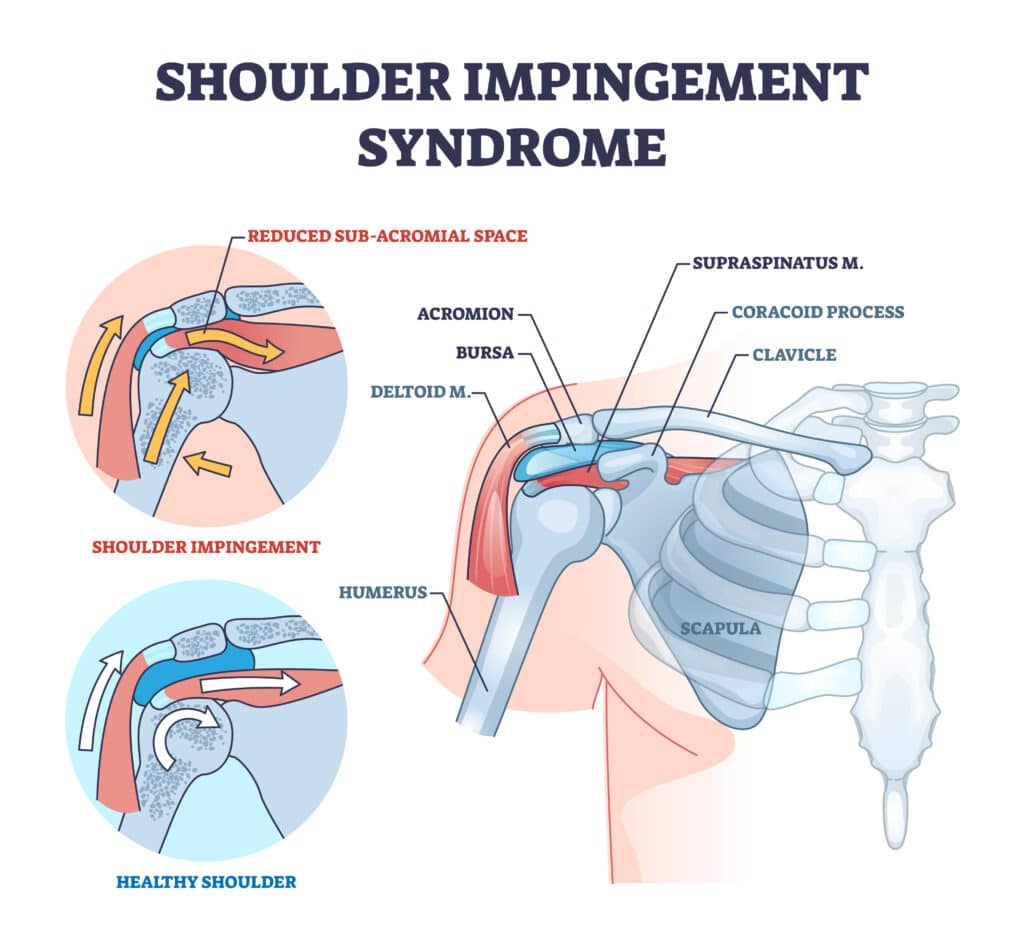 Anatomical image of the structures involved in shoulder impingement.