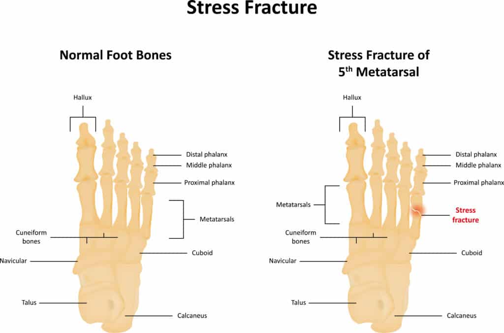 Graphic of fifth metatarsal stress fracture