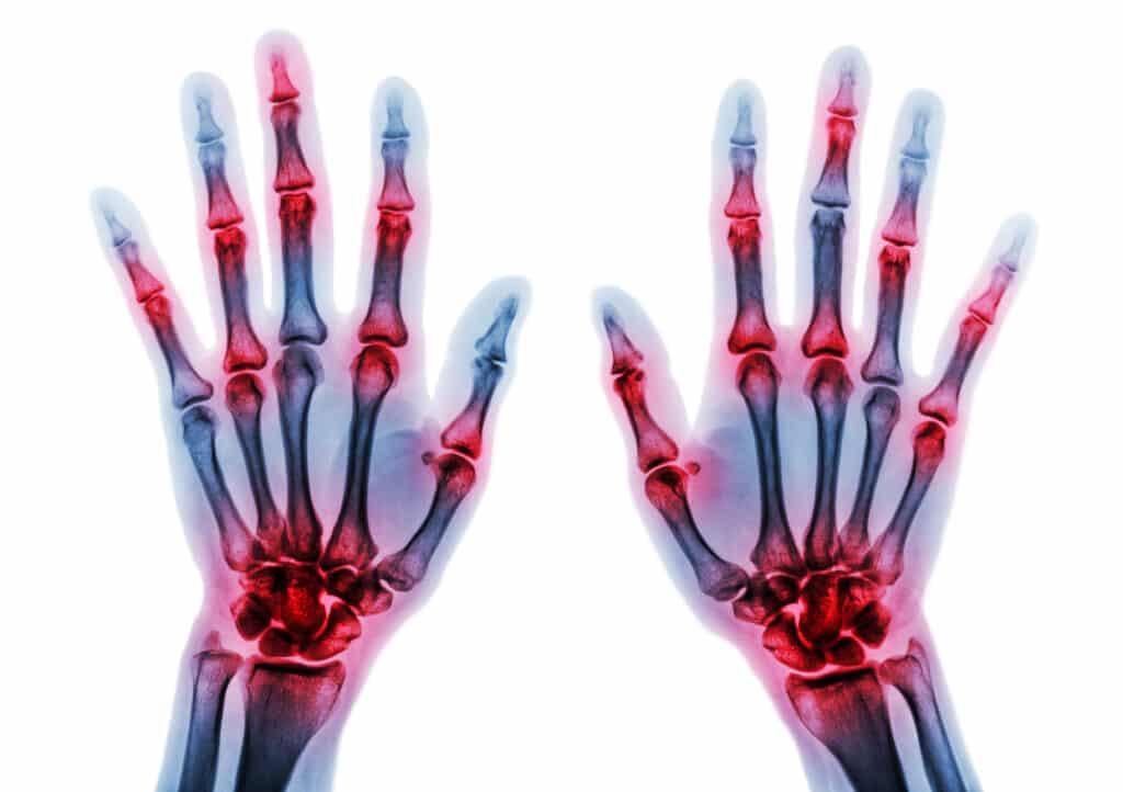 Image of hand Xrays with emphasis on arthritis in the wrists, hands and fingers on a white background.