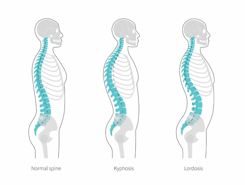 Diagram of a normal spine, a kyphotic spine and a lordotic or "swayback" spine.
