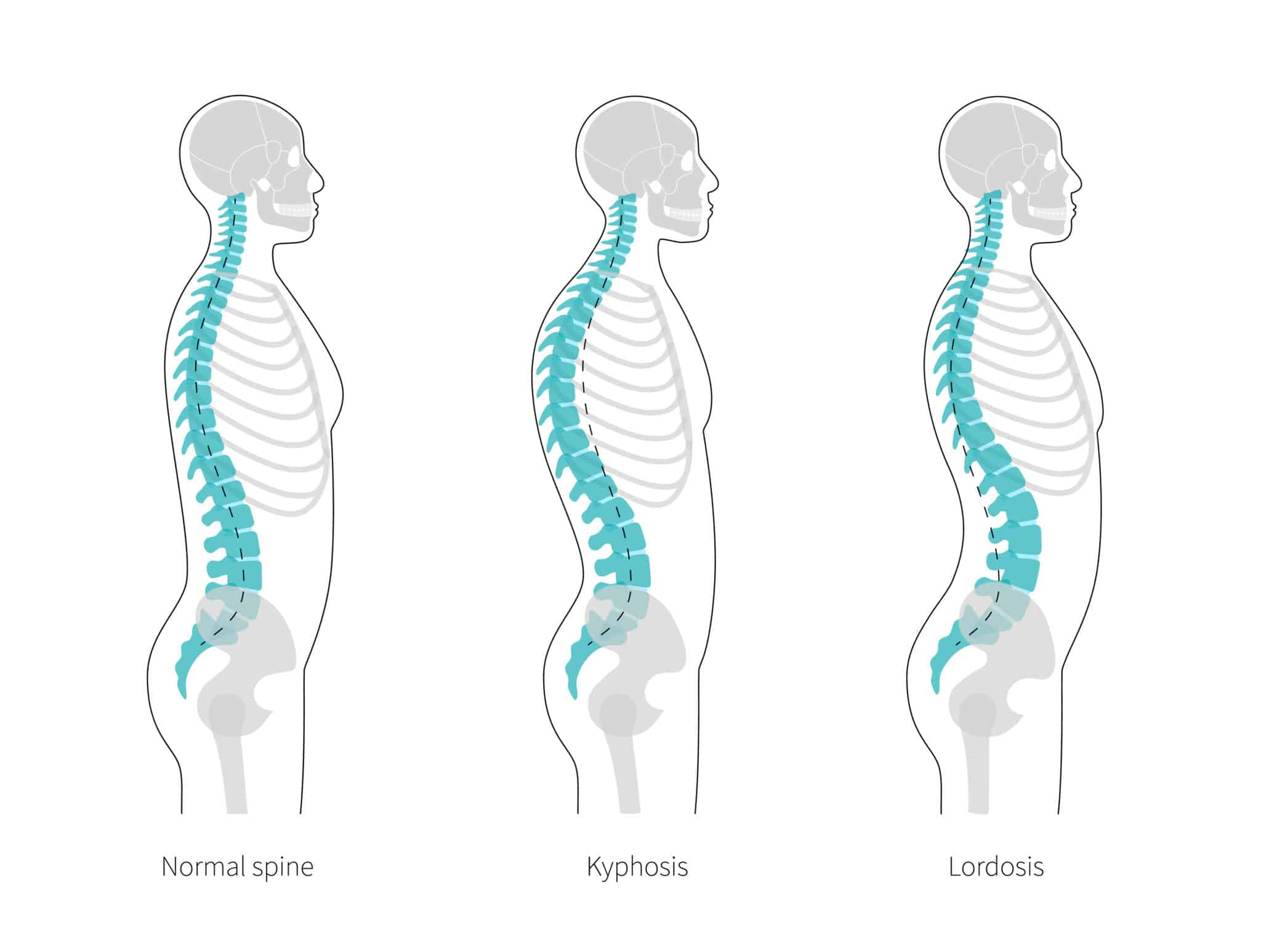 Swayback Posture: Causes, Risks, and Treatment - Physio Ed.