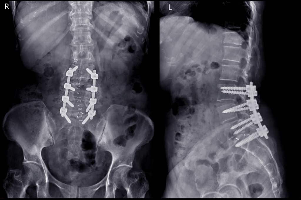 X-ray image of lambosacral spine or L-S spine AP and lateral Post operative  Lumbar Plates and screw.  People with these sorts of procedures are not advised to do spinal decompression at home