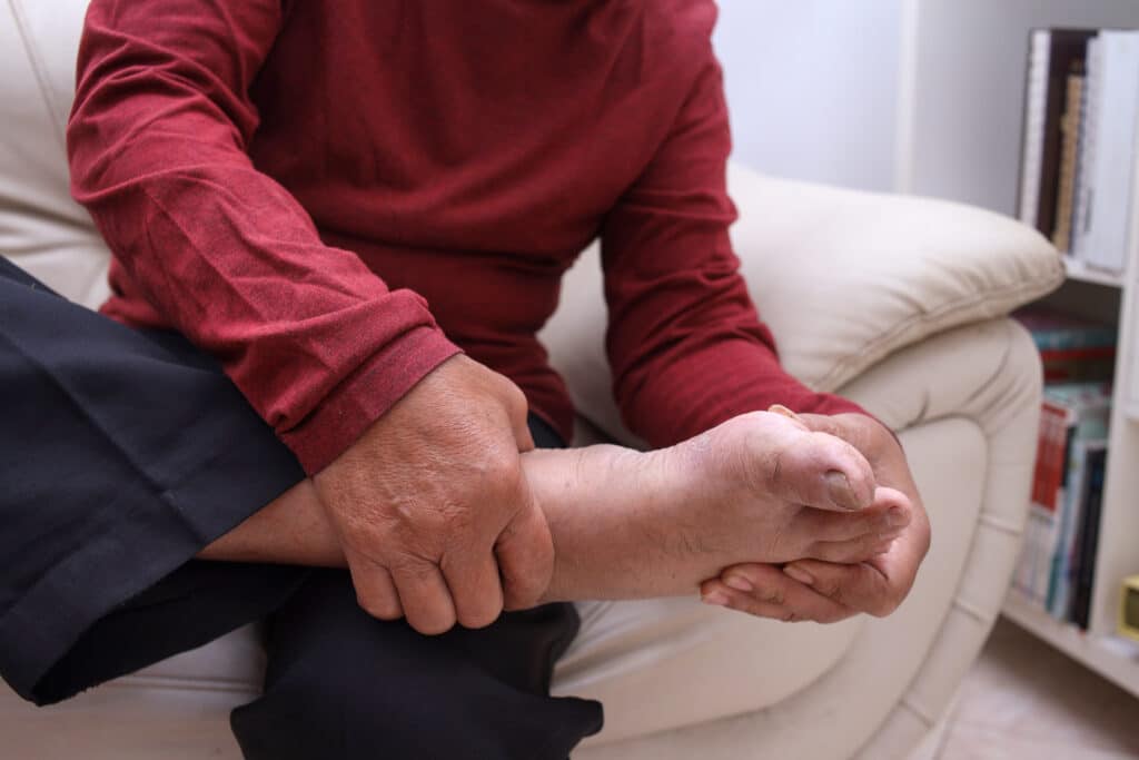 Image of a senior man rubbing his heel and arch because of heel pain