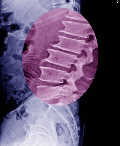 Lumbar spine x-ray show spur of vertebral body.