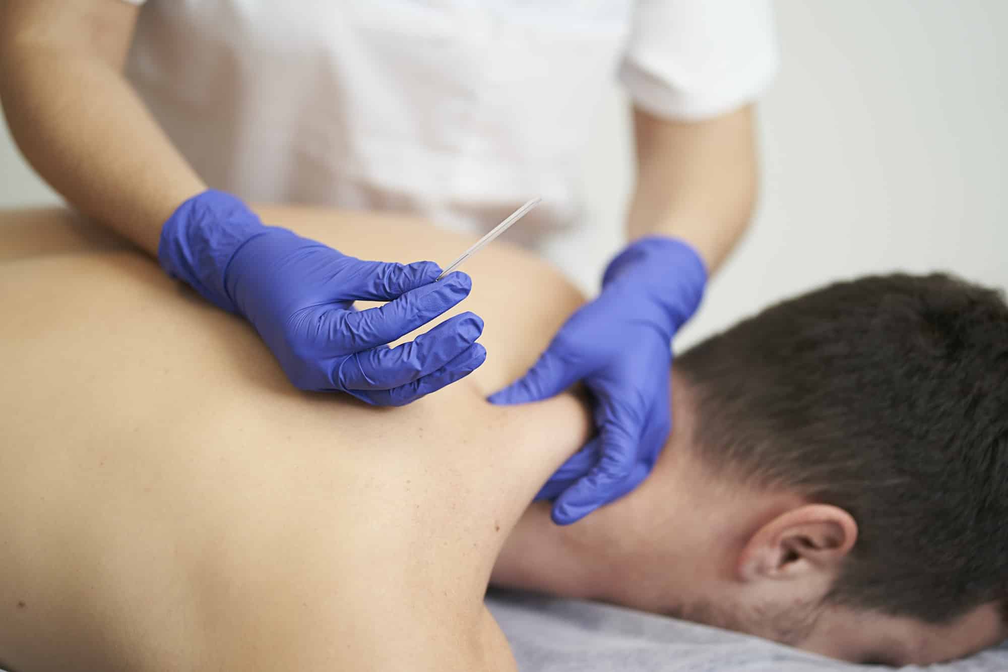 physical therapist treating an overload with dry needling